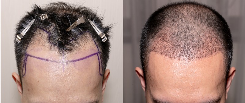 Hair Transplant in Turkey Before and After