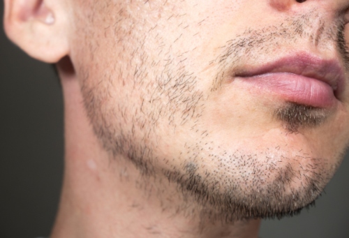 The steps of beard transplant treatments
