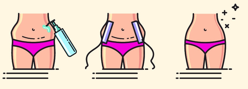 Laser liposuction in Turkey