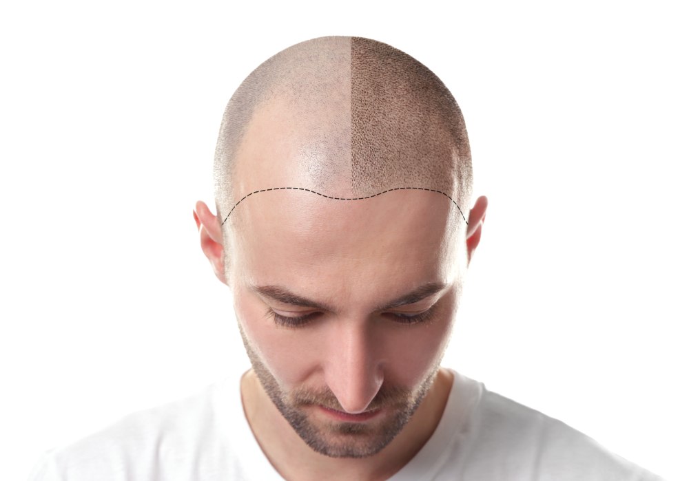 Hair transplant procedures in Turkey