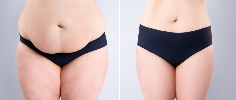 Liposuction in Turkey Before and After