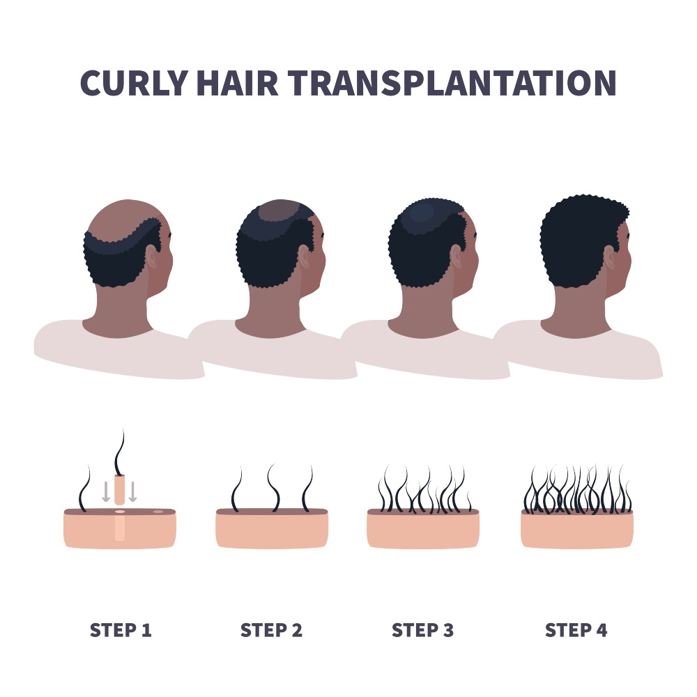 Curly hair transplant