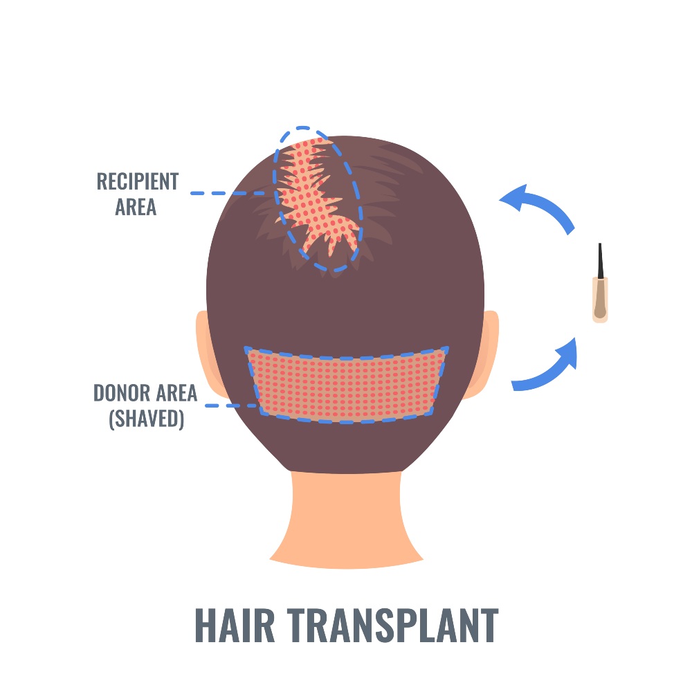 DHI Hair Transplantation