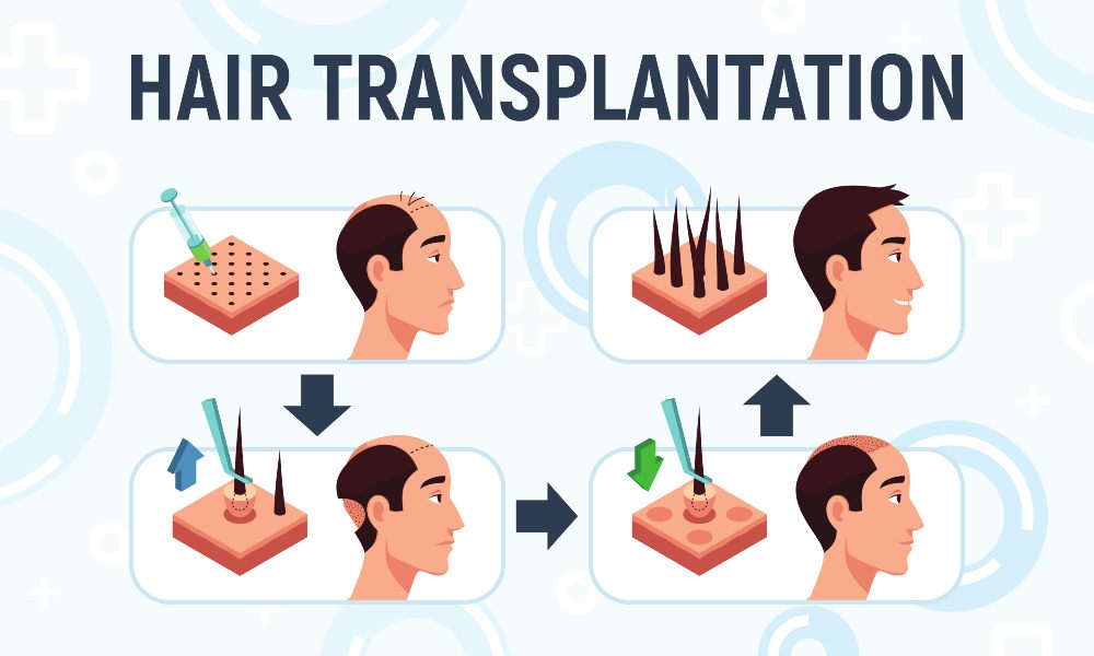 Hair transplantation process in Turkey