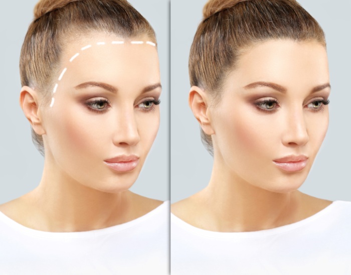 Hairline lowering procedure