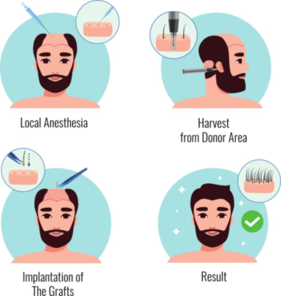 Artas Hair Transplant