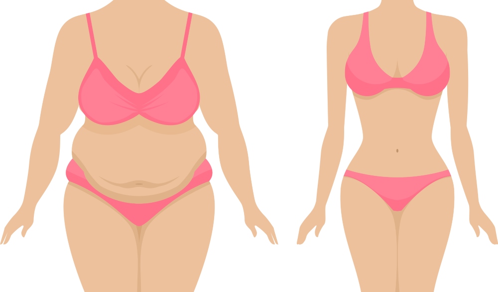 Gastric Sleeve Bariatric Surgery Aftercare in Turkey