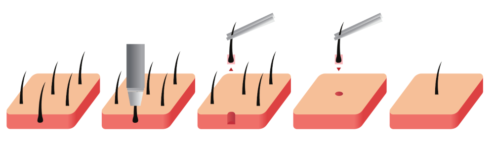 Micro FUE Hair Transplant