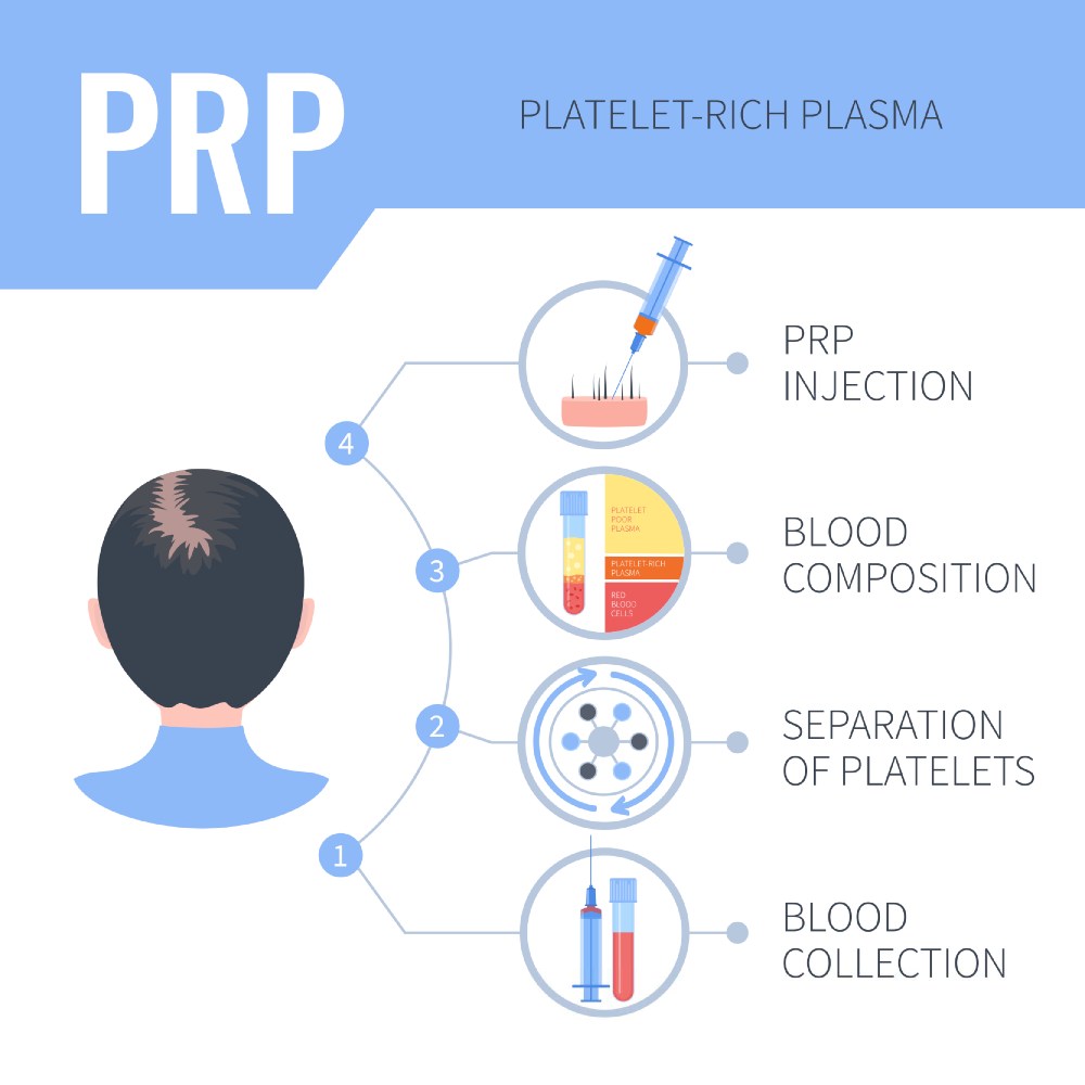 PRP hair treatment