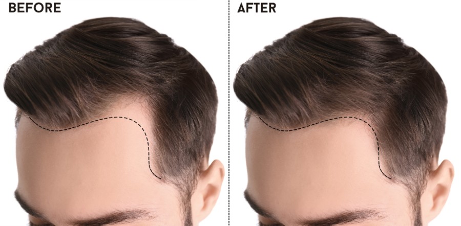 Robotic Hair Transplant Before and After