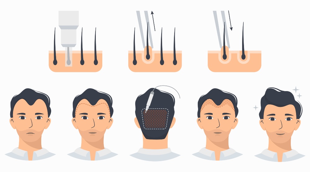 Robotic Hair Transplant At Bookmedi In Turkey Robotic Hair Transplant At Bookmedi In Turkey