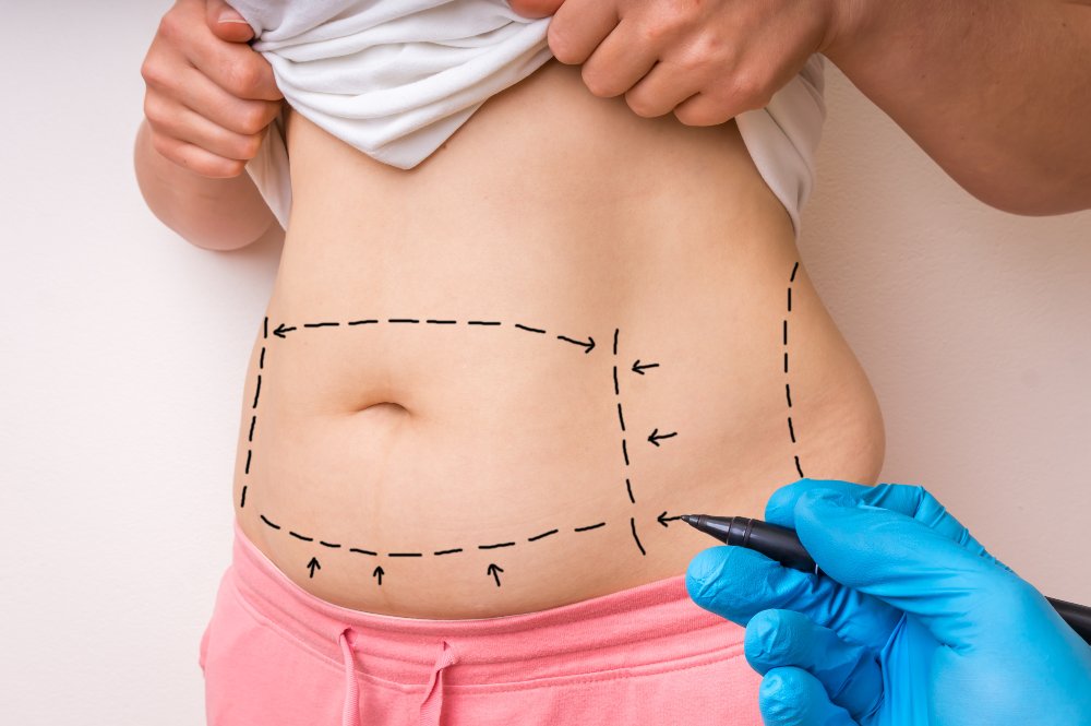 Tummy Tuck in Turkey