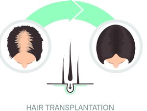 Biofibre hair implant in Turkey