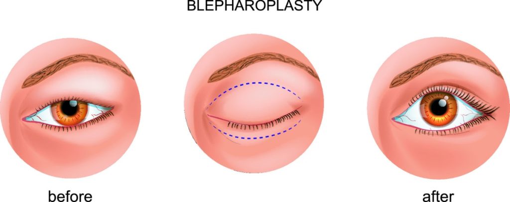 Blepharoplasty in Turkey