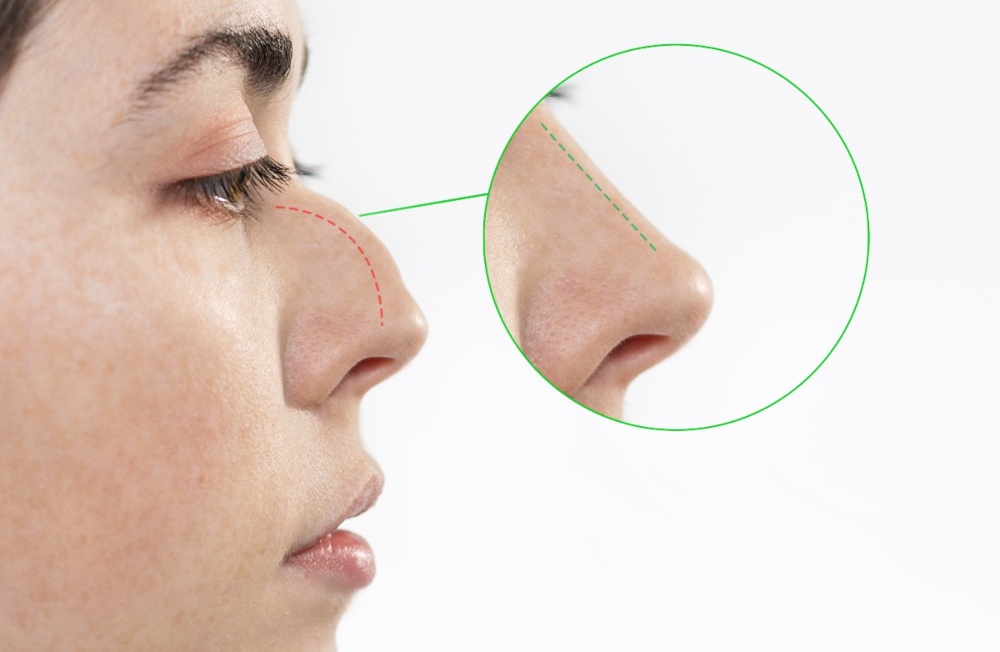 Rhinoplasty in Turkey