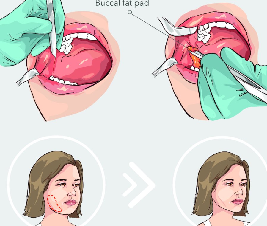 Removing Buccal Fat in Turkey