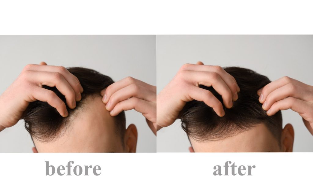 Micro FUE Hair Transplant before-after