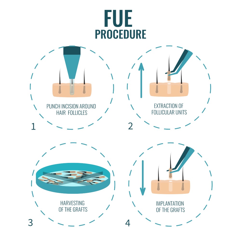 FUE Hair Transplant in Turkey