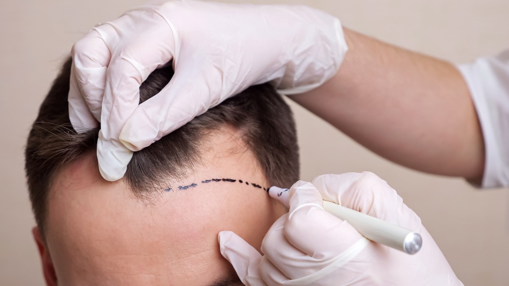 Micro FUE Hair Transplant