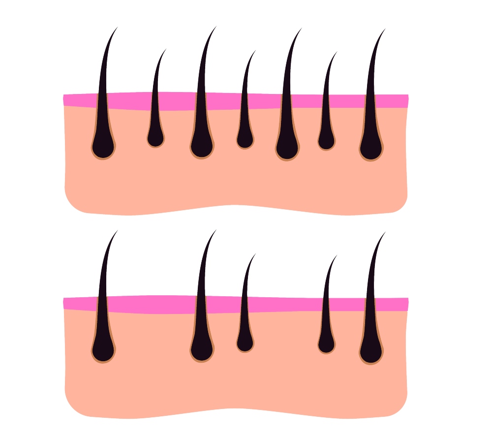 FUT Hair Transplant Cost in Turkey?