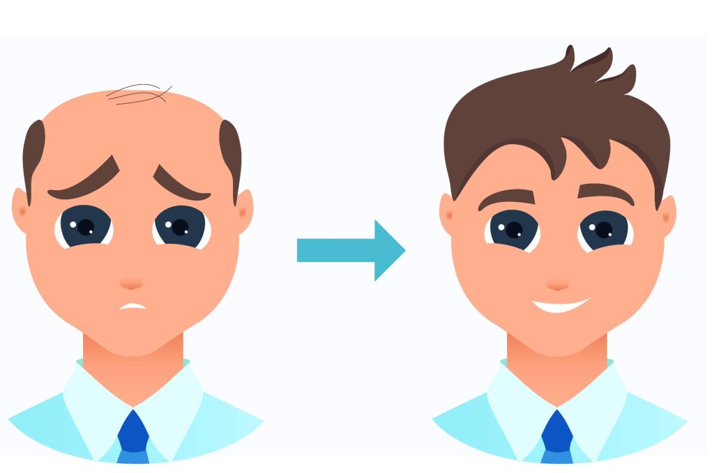 FUT Hair Transplant in Turkey