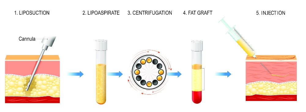 lipofilling in Turkey