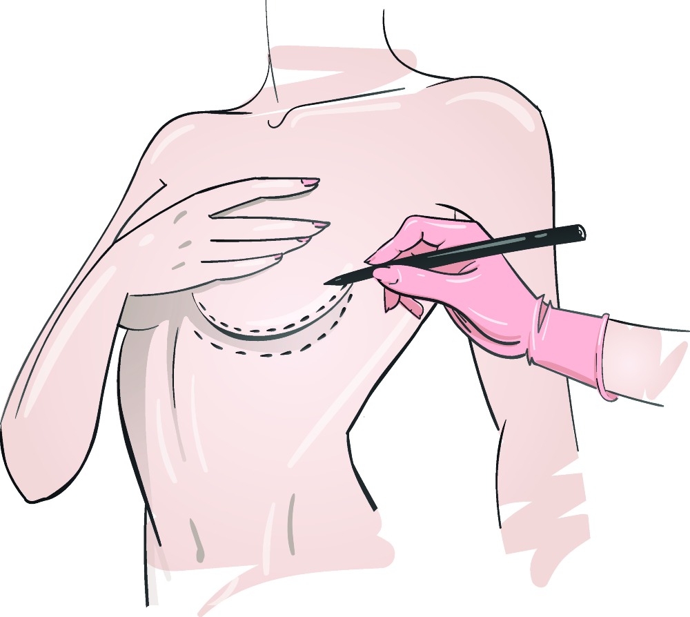 Breast Lift in Turkey