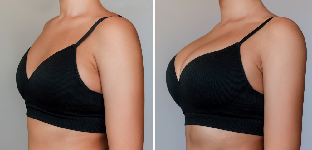 Breast Lift in Turkey before and after