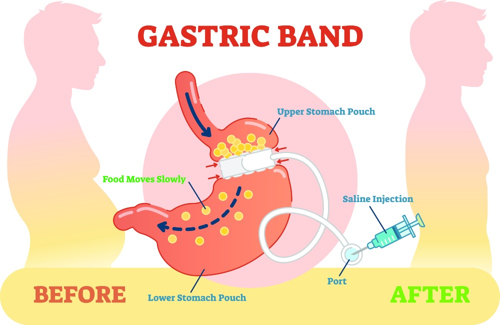 Gastric Banding Surgery Turkey for Weight Loss
