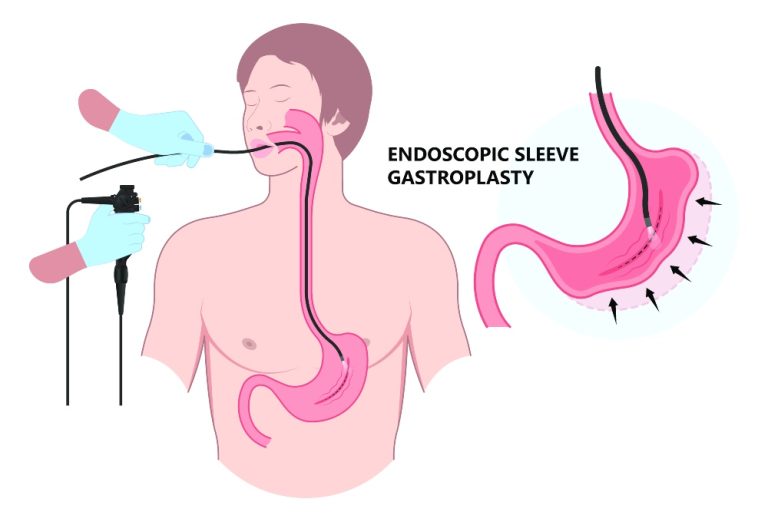 How is Gastric Sleeve Surgery Done in Turkey_