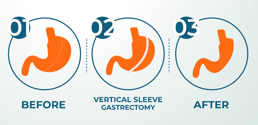 What Is Included in a Gastric Sleeve Turkey Package