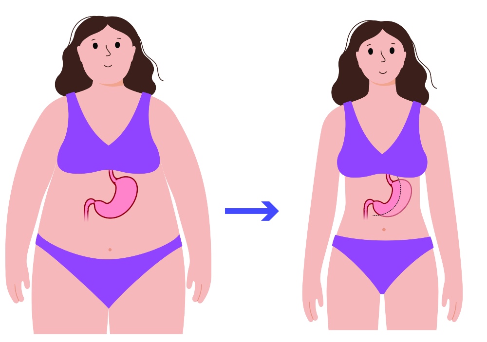 What Is the Gastric Sleeve Cost Turkey_