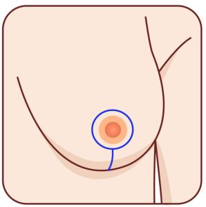 Vertical Breast Reduction