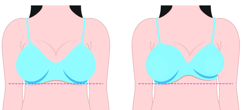 What is Breast Reduction In Turkey_